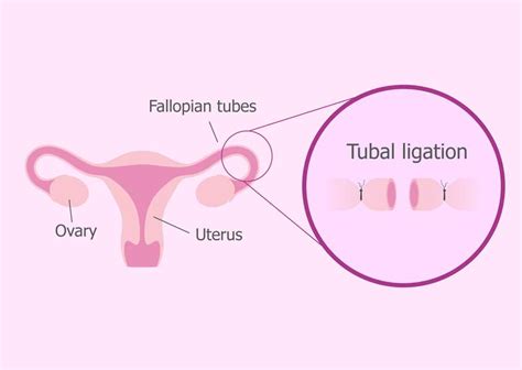 Discover the Benefits of Non Invasive Tubal Ligation: No Surgery Required!
